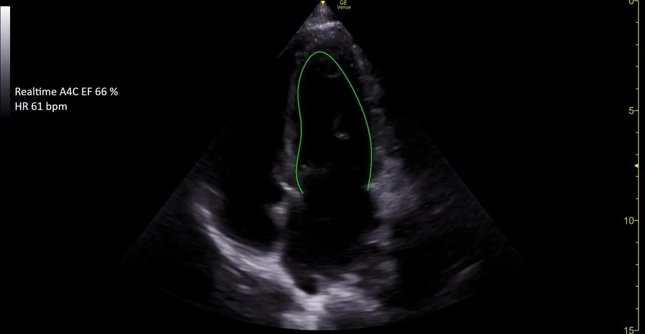 Lung Sweep (DROP SHIP ONLY) (Continental US Only) (Not Available to Vet or Government Markets) (Pricing Listed is an Estimate and may Change without Prior Notification; Please Contact your GE Sales Rep for an Accurate Price Quote) 