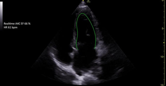 Lung Sweep (DROP SHIP ONLY) (Continental US Only) (Not Available to Vet or Government Markets) (Pricing Listed is an Estimate and may Change without Prior Notification; Please Contact your GE Sales Rep for an Accurate Price Quote) 