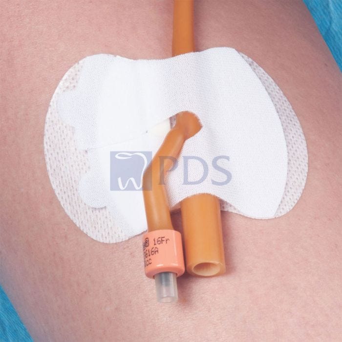 Securement Device, Pediatric Foley Catheter, Sterile, Individually Packaged, 100/bx